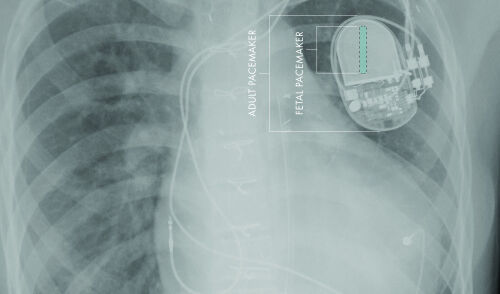 SC CTSI-Supported Researchers Develop First Fully-Implantable Micropacemaker Designed for Fetal Use