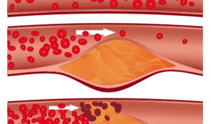 Cross-Institutional Study Looks within Arteries to Understand Effects of Cholesterol Medications 