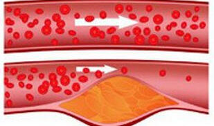 Cross-Institutional Study Looks within Arteries To Understand Effects Of Cholesterol Medications