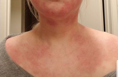 Meta-analysis by USC Researchers Shows Severe Eczema Associated with Increased Risk of Suicide