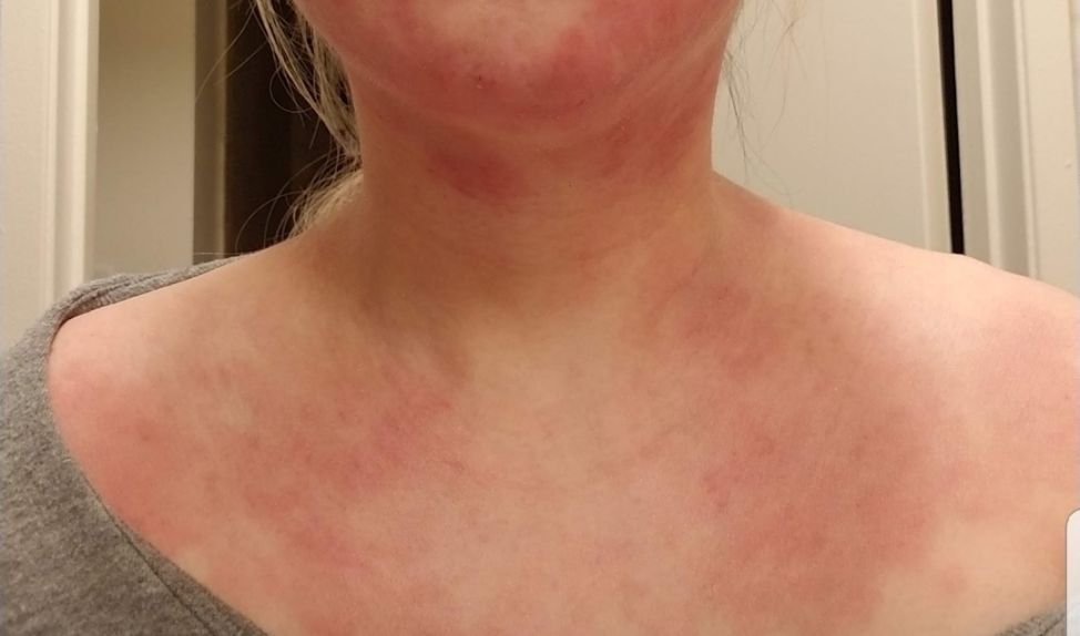 Meta-analysis by USC Researchers Shows Severe Eczema Associated with Increased Risk of Suicide