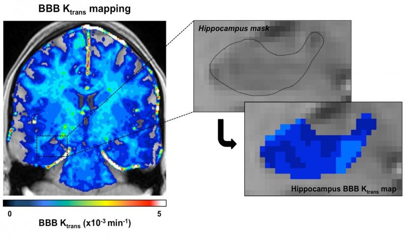 SC CTSI-Supported Research Finds that Aging Brain Issues are Linked to Dementia