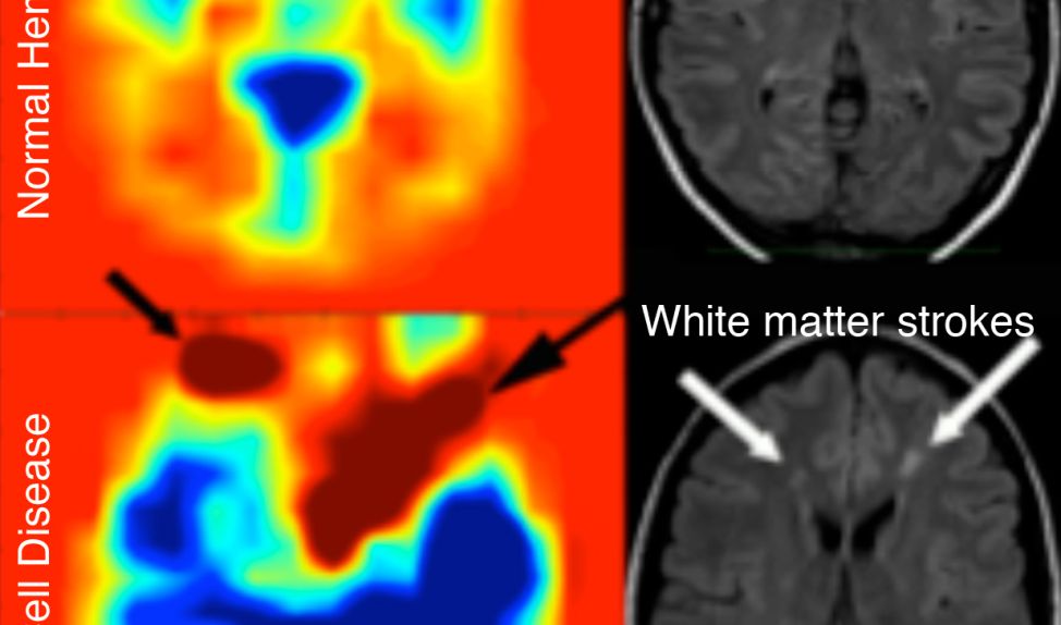 USC Researchers Determine Stroke Risk in Sickle Cell Disease Patients