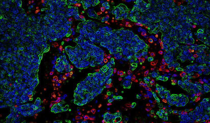 SC CTSI grant-supported research reveals why breast cancer spreads to the brain