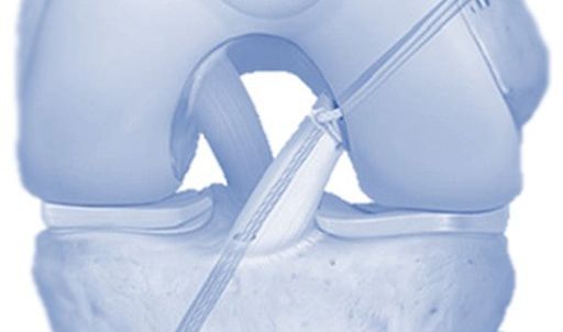 SC CTSI-Supported Pilot Suggests Promise of Testosterone Supplementation to Enhance Recovery from Knee Surgery