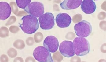 CHLA Researchers Demonstrate How Obesity Blocks Therapeutic Effects of Cancer Treatments