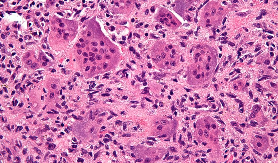 Using Circulating Tumor Cells to Assess a Patient’s Response to Therapy in Real Time
