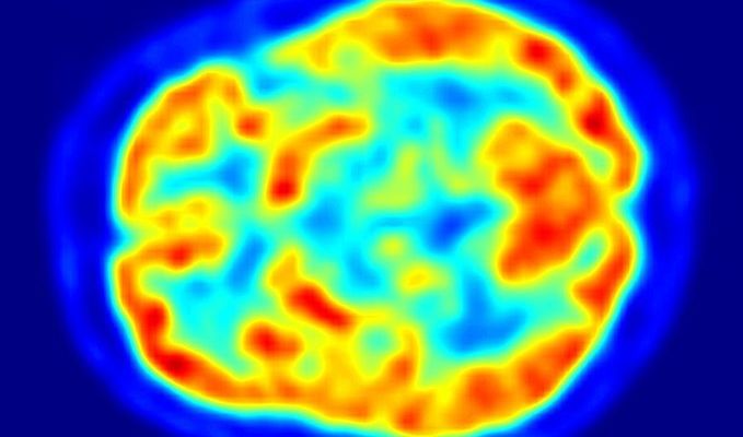 Implantable Pump to Deliver Tumor-Fighting Drugs in the Brain