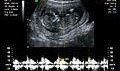 Research Team Develops Pacemaker to Save the Lives of Unborn Babies