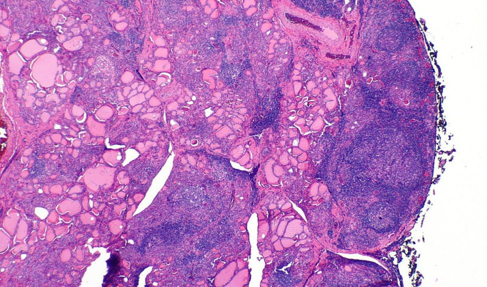 Using Novel Magnetic Resonance Imaging Application to Understand Thyroid Disorders in Children