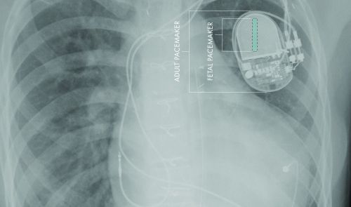 SC CTSI-Supported Researchers Develop First Fully-Implantable Micropacemaker Designed for Fetal Use