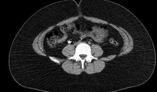 SC CTSI-Supported Study Links Congenital Adrenal Hyperplasia to Cardiovascular Disease in Teens